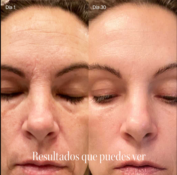 antes y despues solawave luz roja facial resultados en piel